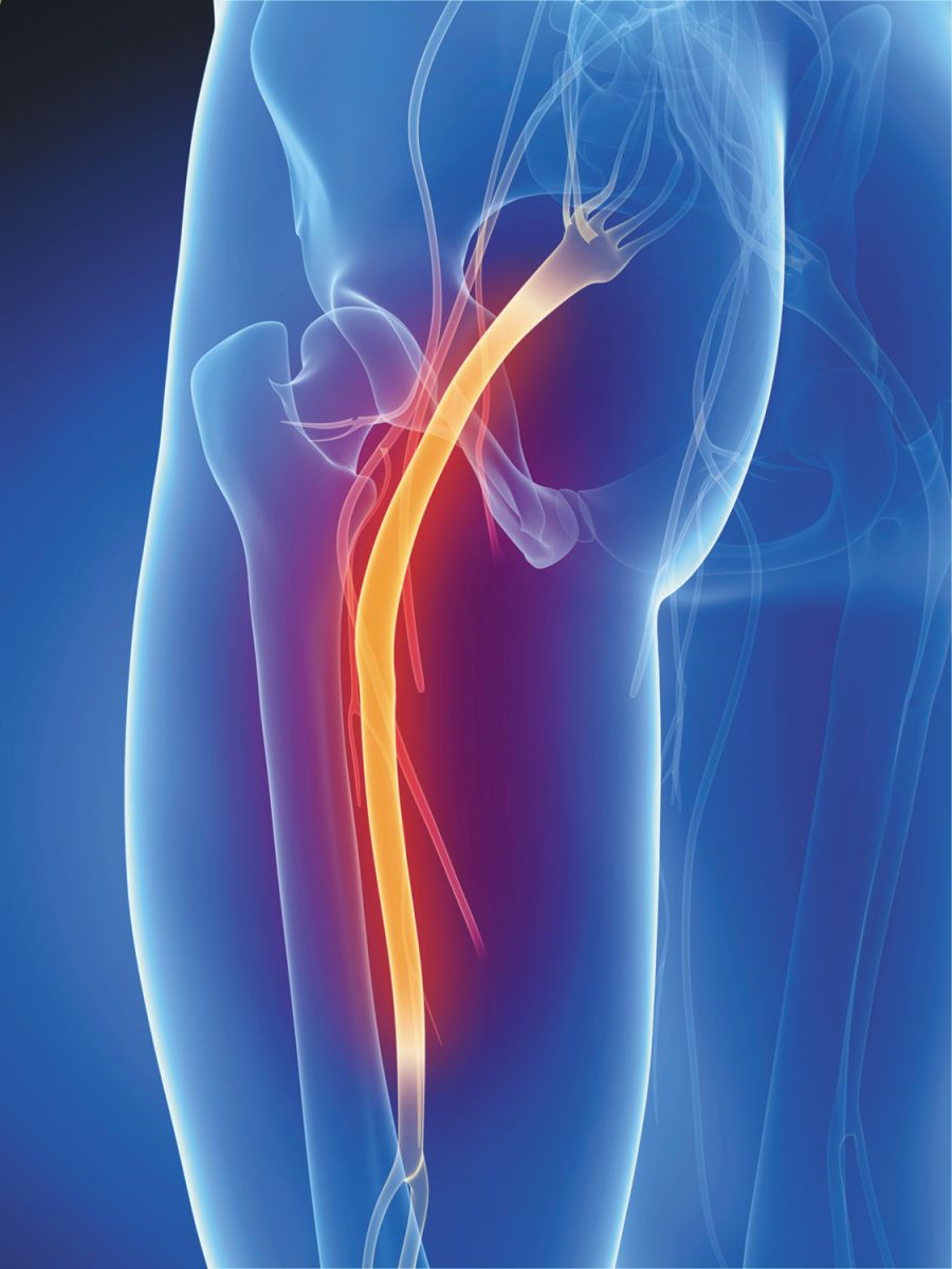 Read more about the article Get Sciatica Pain Relief!